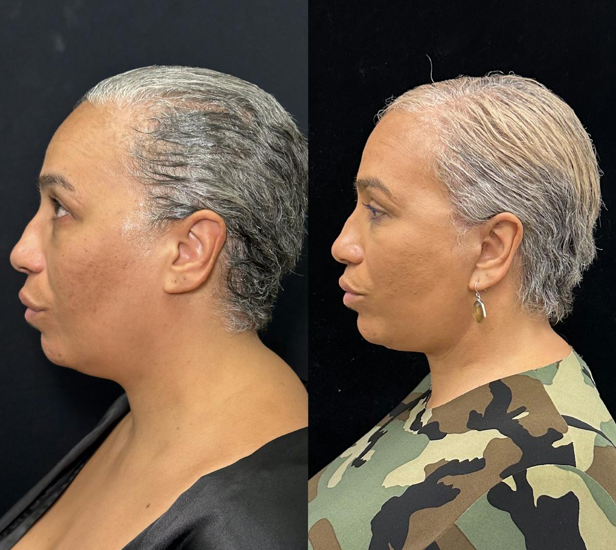 Deep Plane Facelift Before & After Gallery - Patient 117019 - Image 4