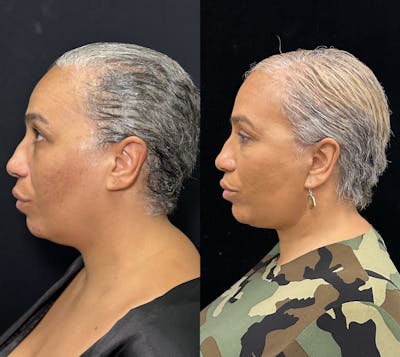 Deep Plane Facelift Before & After Gallery - Patient 117019 - Image 4
