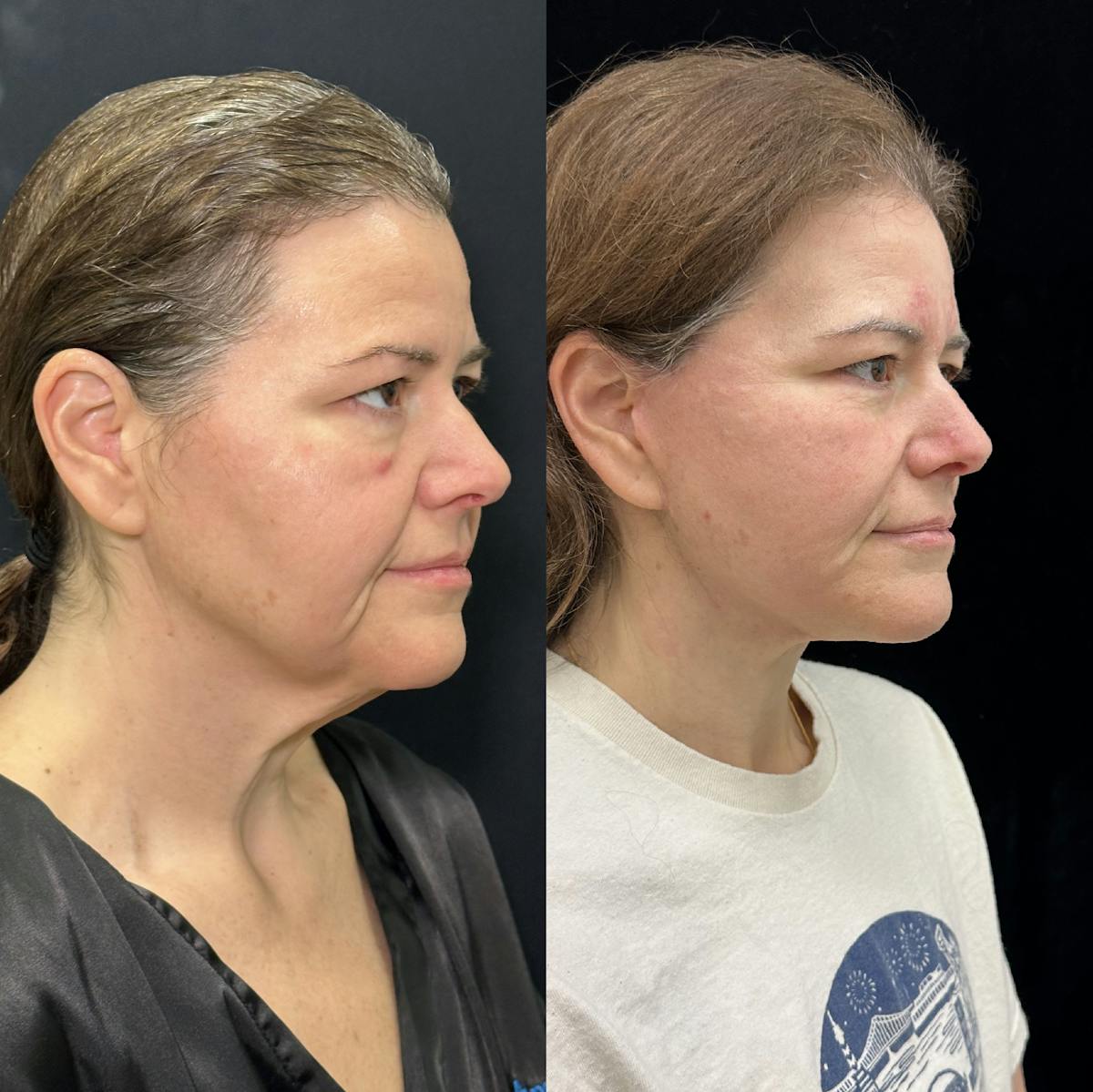 Deep Plane Facelift Before & After Gallery - Patient 336907 - Image 2