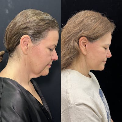 Deep Plane Facelift Before & After Gallery - Patient 336907 - Image 3