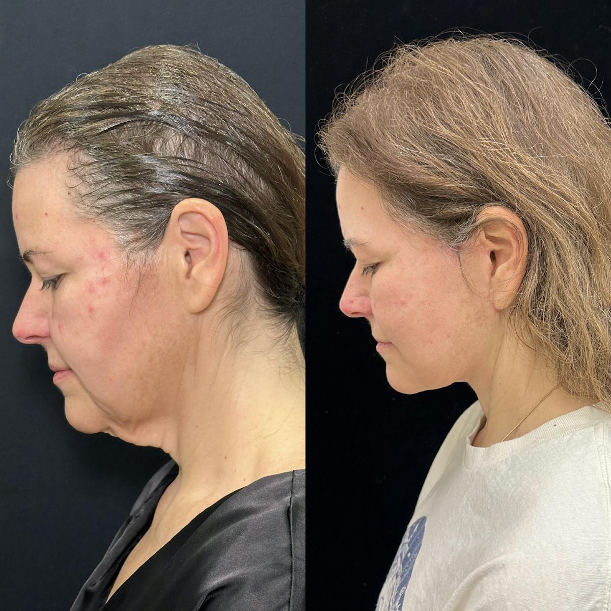 Deep Plane Facelift Before & After Gallery - Patient 336907 - Image 6