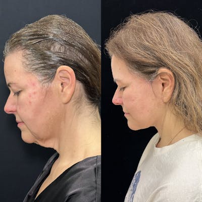 Deep Plane Facelift Before & After Gallery - Patient 336907 - Image 6