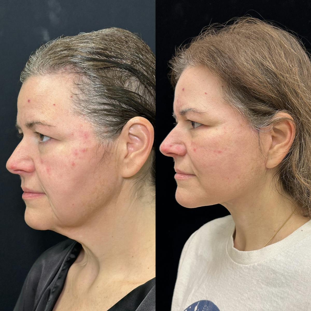 Deep Plane Facelift Before & After Gallery - Patient 336907 - Image 5