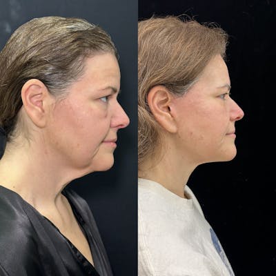 Deep Plane Facelift Before & After Gallery - Patient 336907 - Image 1