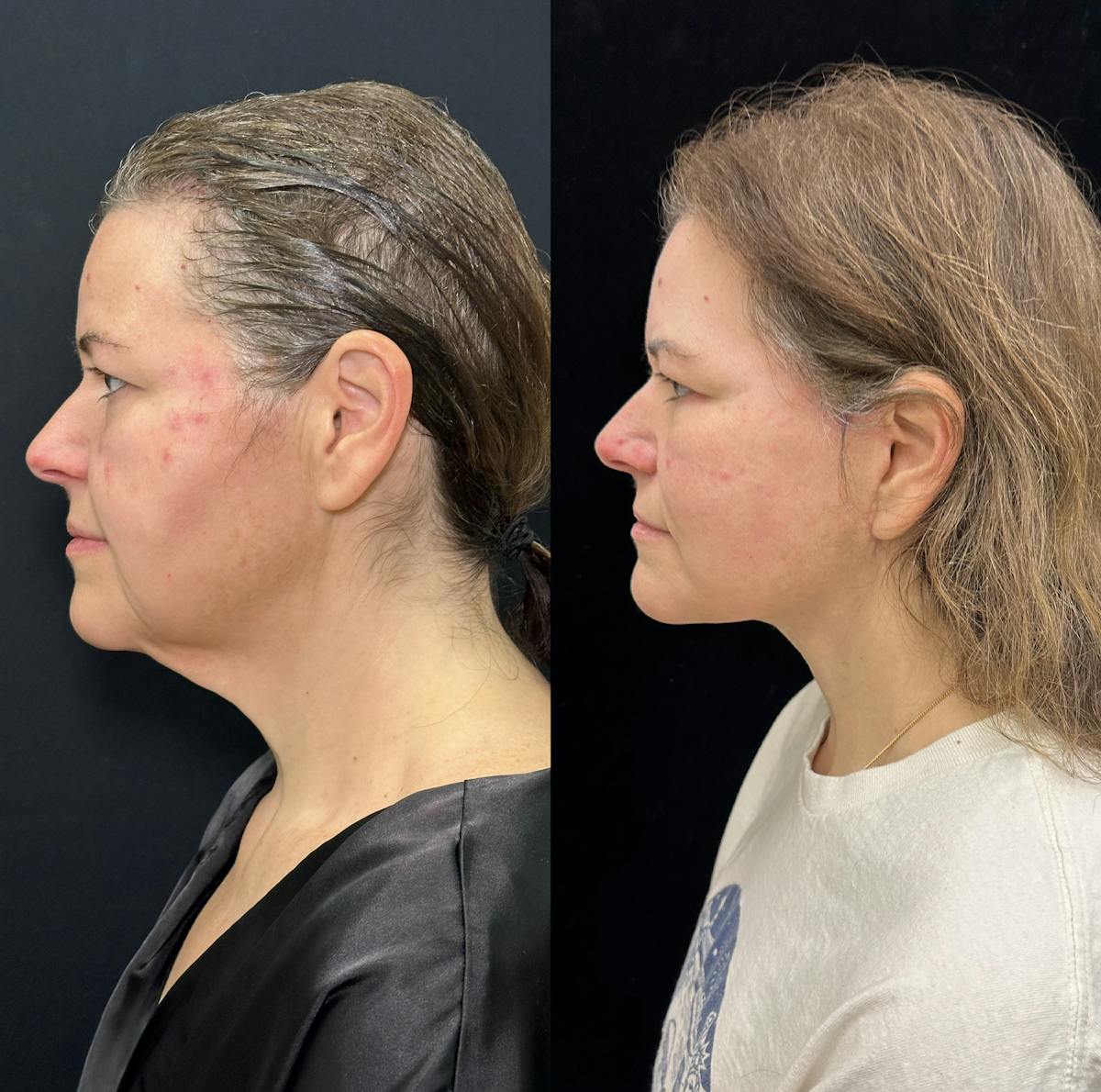 Deep Plane Facelift Before & After Gallery - Patient 336907 - Image 4