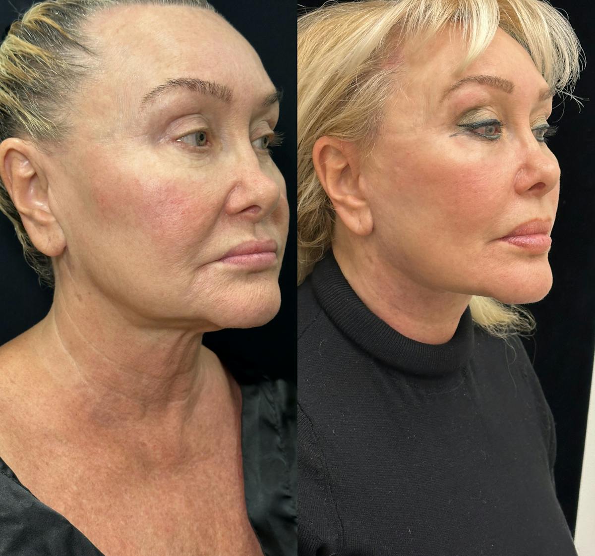 Deep Plane Facelift Before & After Gallery - Patient 271612 - Image 1