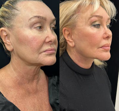 Deep Plane Facelift Before & After Gallery - Patient 271612 - Image 1