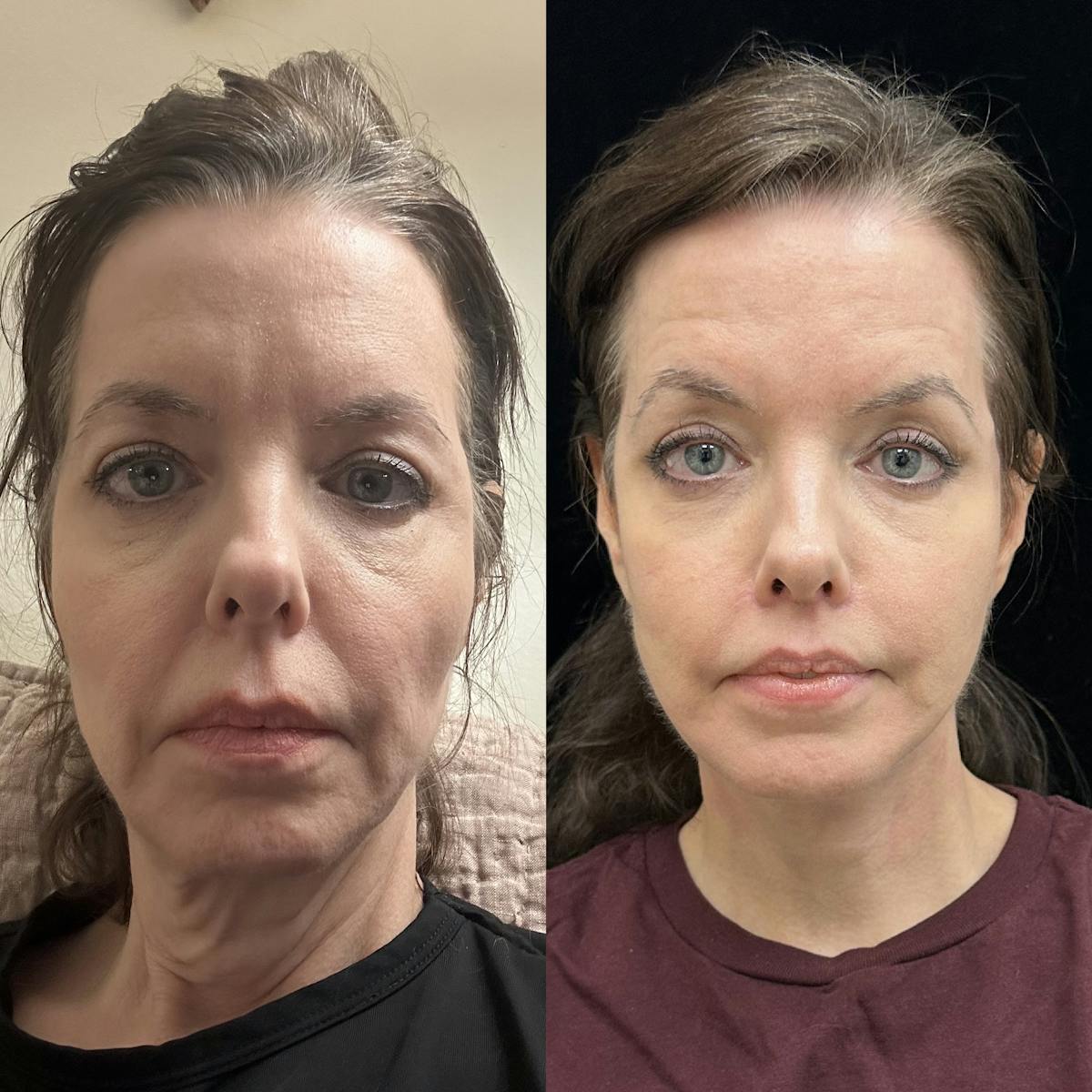 Deep Plane Facelift Before & After Gallery - Patient 173058 - Image 1