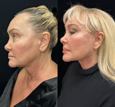 Deep Plane Facelift Before & After Gallery - Patient 271612 - Image 3