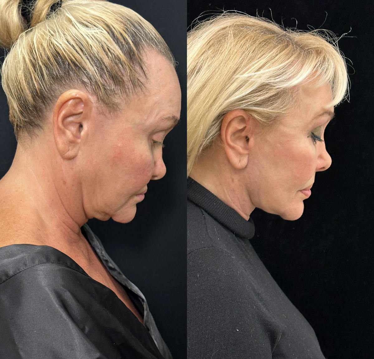 Deep Plane Facelift Before & After Gallery - Patient 271612 - Image 2