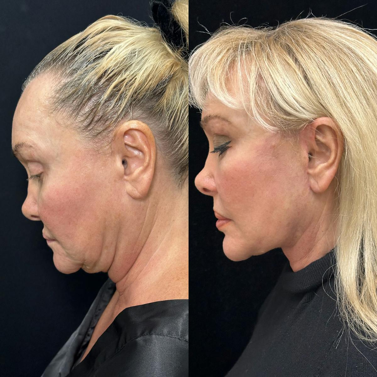 Deep Plane Facelift Before & After Gallery - Patient 271612 - Image 4