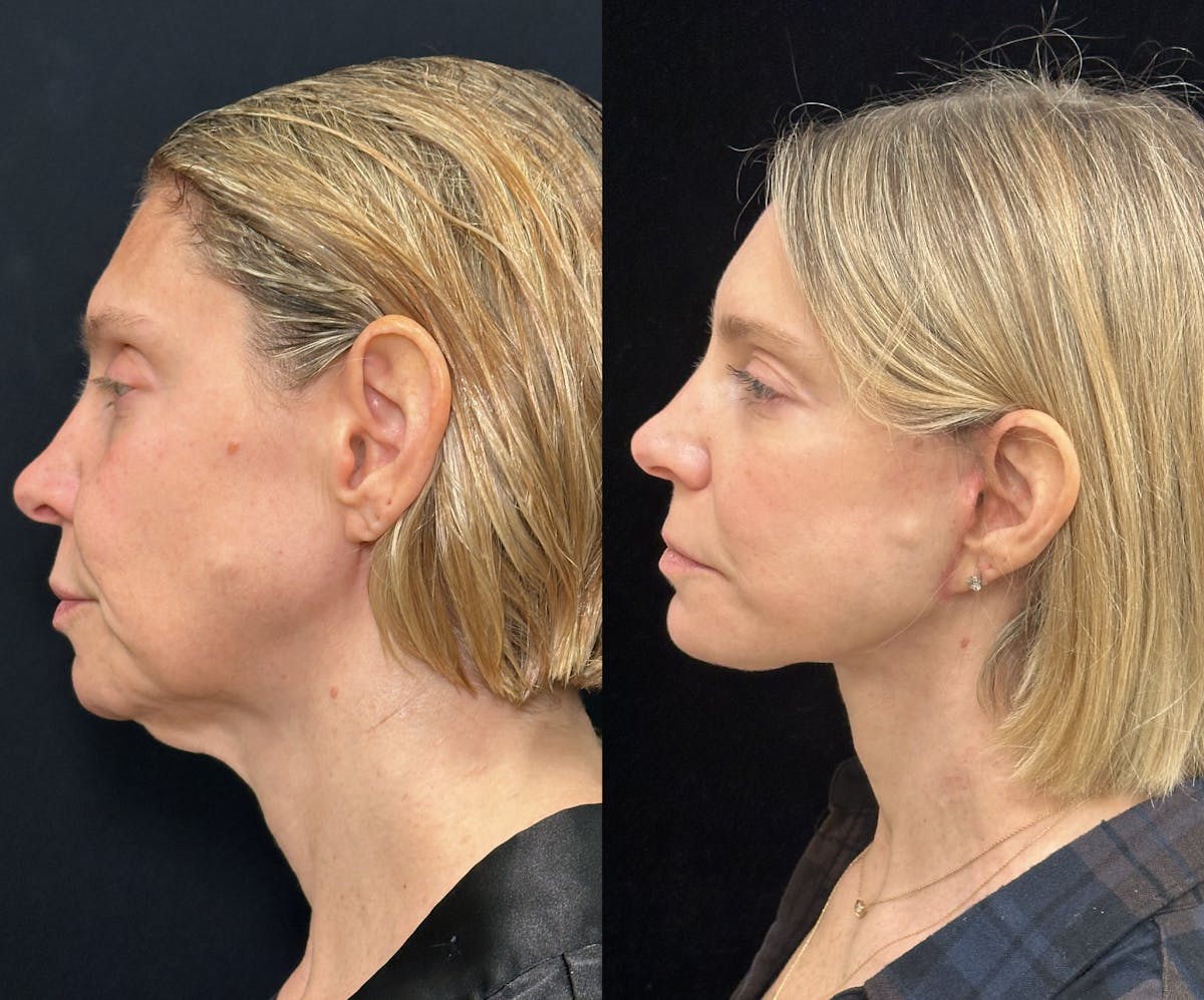 Deep Plane Facelift Before & After Gallery - Patient 166141 - Image 4