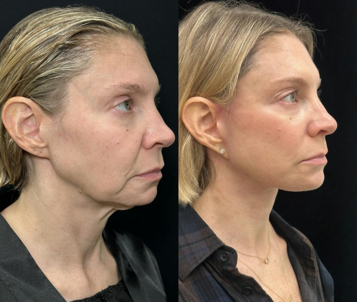 Deep Plane Facelift Before & After Gallery - Patient 166141 - Image 2