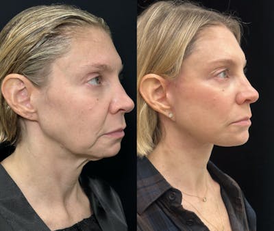 Deep Plane Facelift Before & After Gallery - Patient 166141 - Image 2
