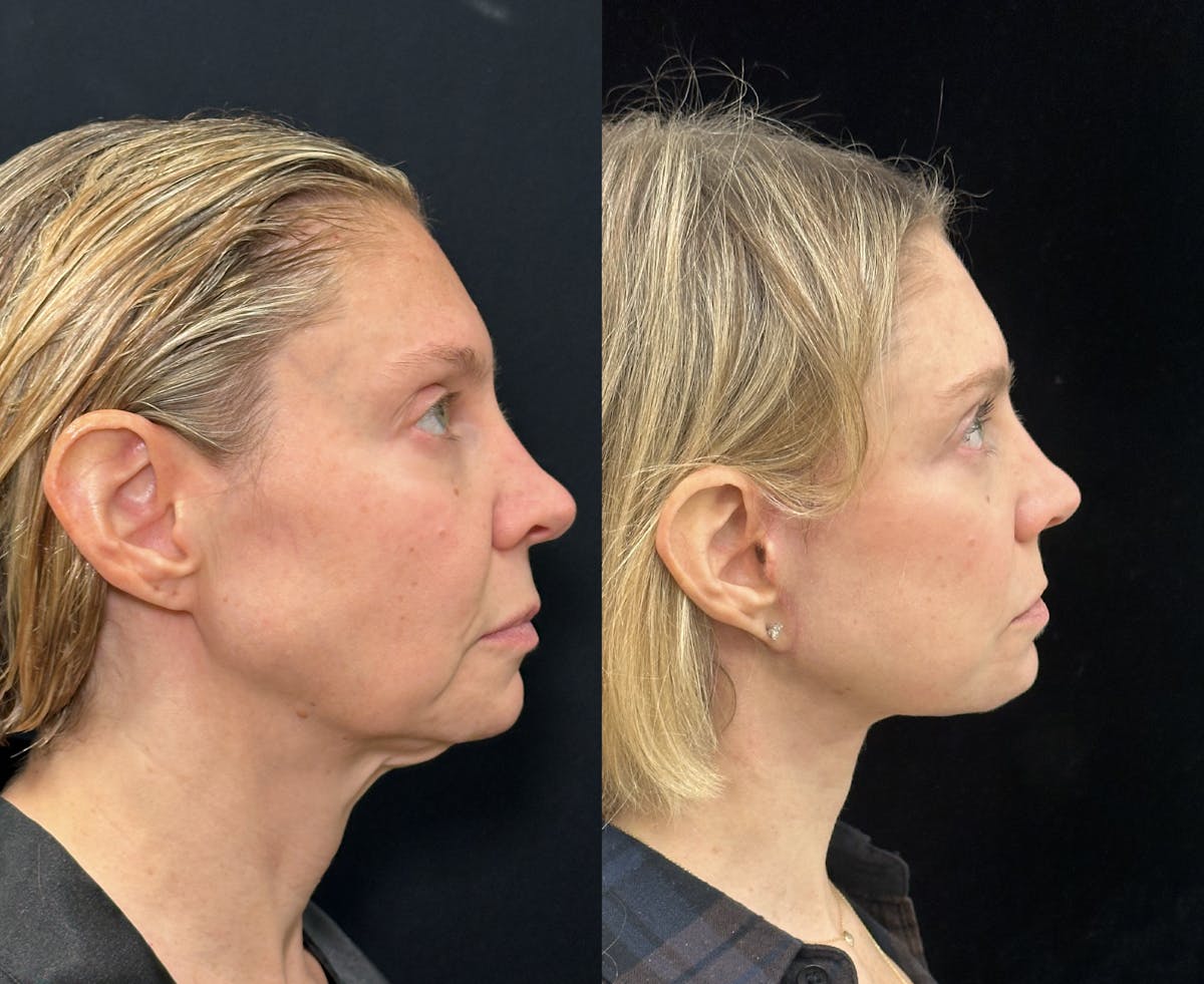 Deep Plane Facelift Before & After Gallery - Patient 166141 - Image 1
