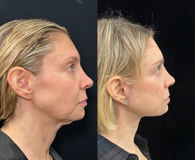 Deep Plane Facelift Before & After Gallery - Patient 166141 - Image 1
