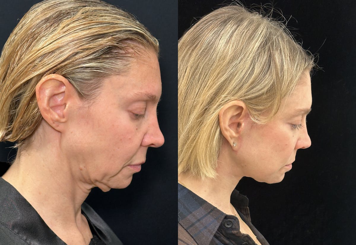 Deep Plane Facelift Before & After Gallery - Patient 166141 - Image 3