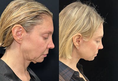 Deep Plane Facelift Before & After Gallery - Patient 166141 - Image 3