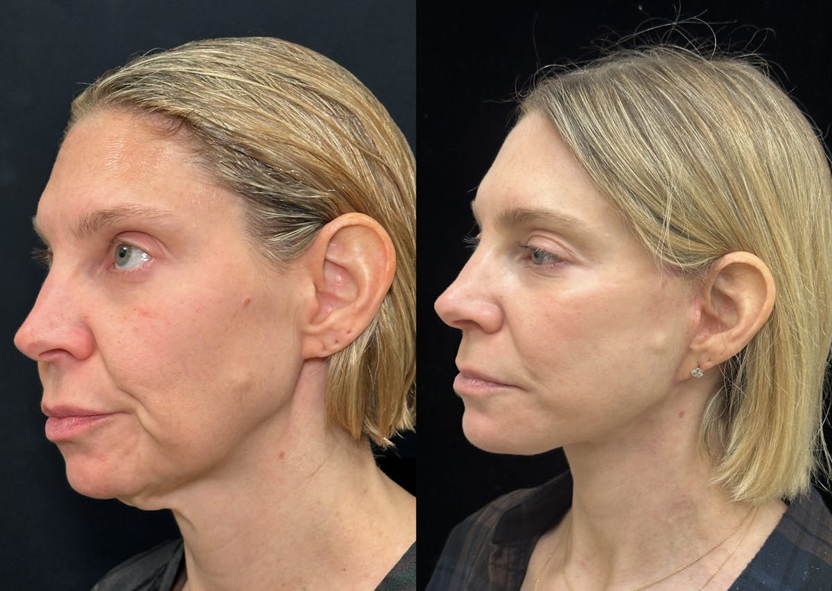 Deep Plane Facelift Before & After Gallery - Patient 166141 - Image 5