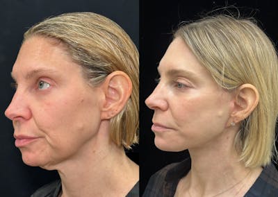 Deep Plane Facelift Before & After Gallery - Patient 166141 - Image 5