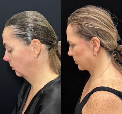 Deep Plane Facelift Before & After Gallery - Patient 171440 - Image 6