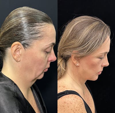 Deep Plane Facelift Before & After Gallery - Patient 171440 - Image 3