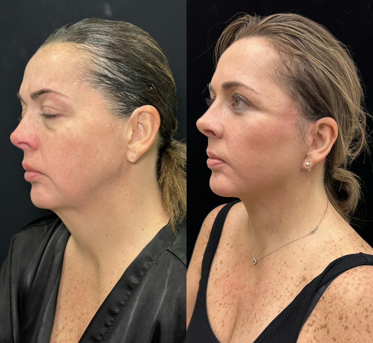 Deep Plane Facelift Before & After Gallery - Patient 171440 - Image 5