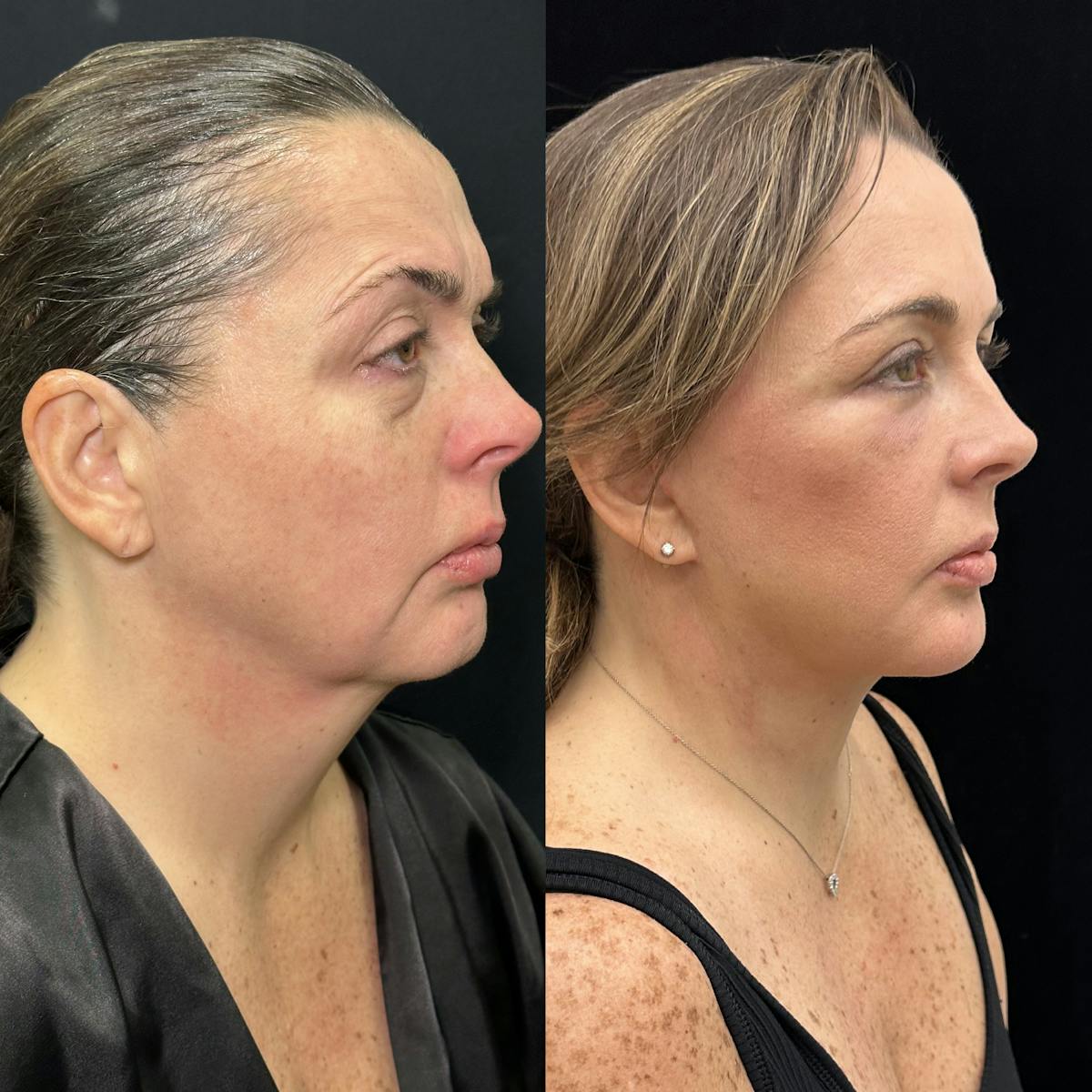 Deep Plane Facelift Before & After Gallery - Patient 171440 - Image 2