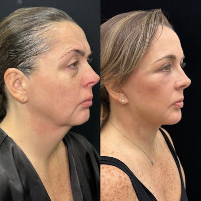Deep Plane Facelift Before & After Gallery - Patient 171440 - Image 2