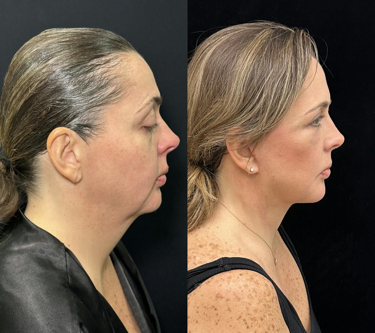 Deep Plane Facelift Before & After Gallery - Patient 171440 - Image 1
