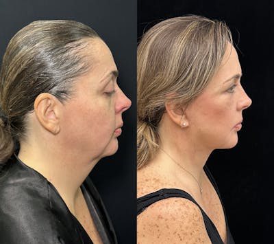 Deep Plane Facelift Before & After Gallery - Patient 171440 - Image 1
