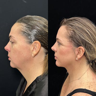 Deep Plane Facelift Before & After Gallery - Patient 171440 - Image 4