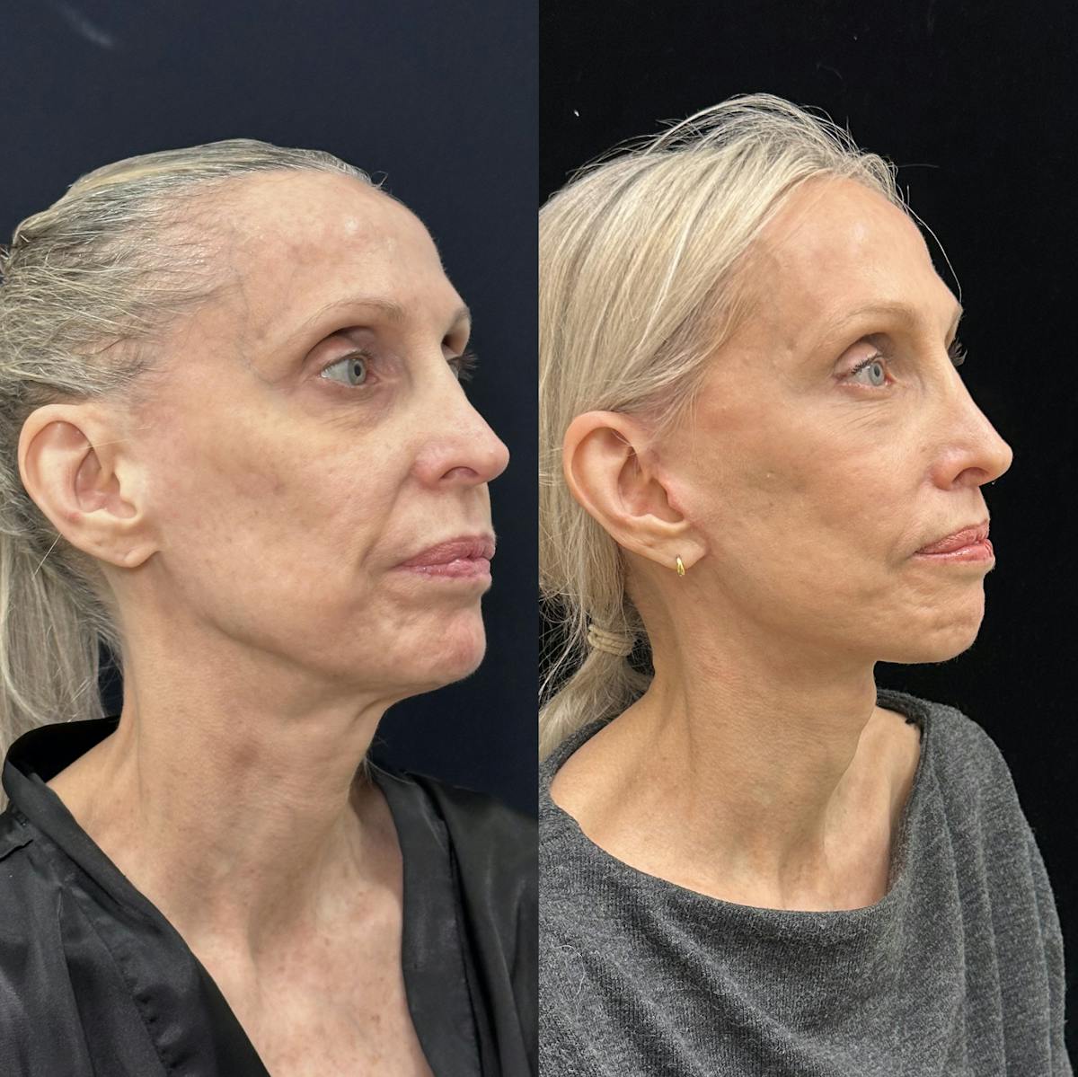 Deep Plane Facelift Before & After Gallery - Patient 988149 - Image 1