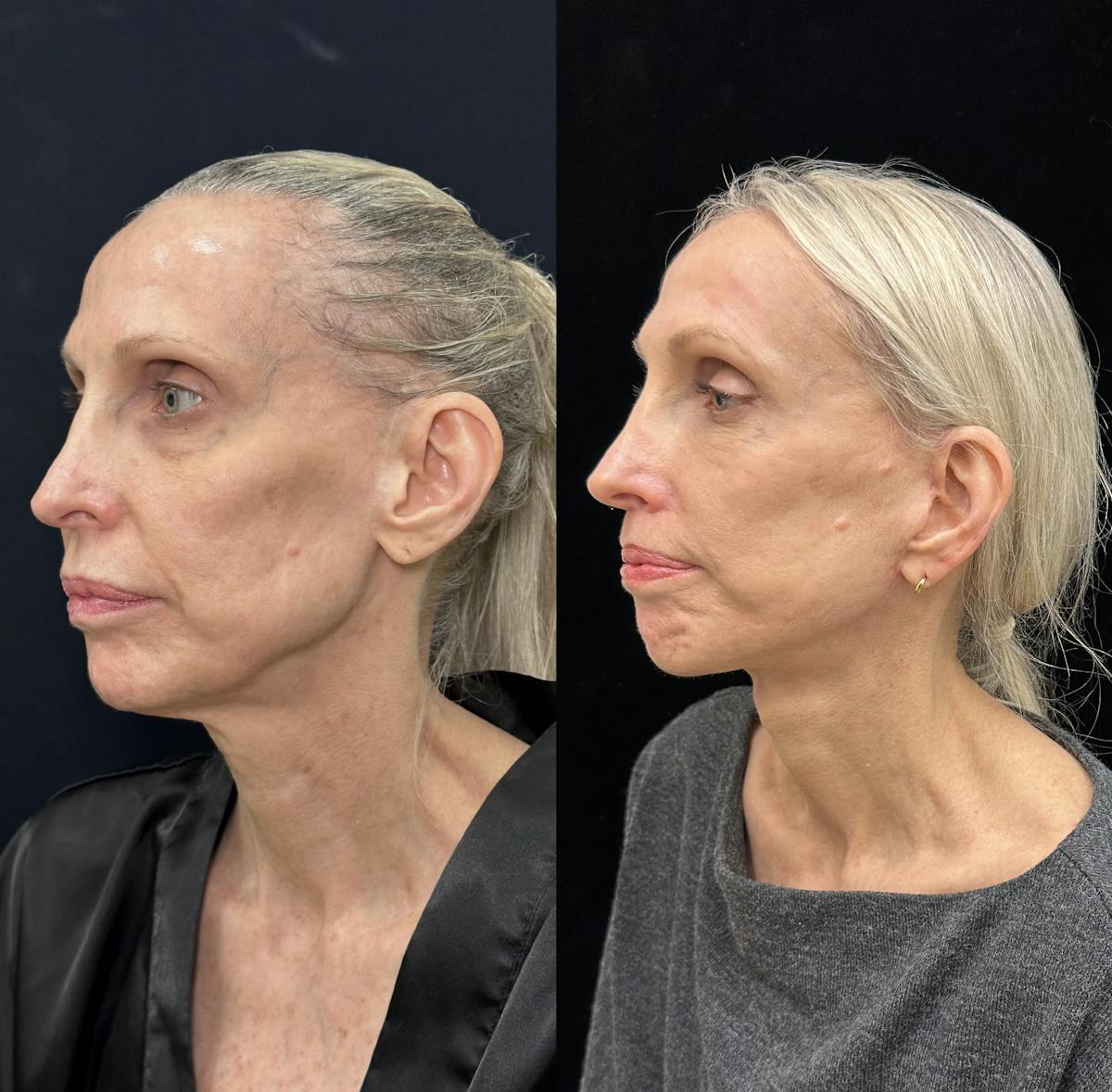 Deep Plane Facelift Before & After Gallery - Patient 988149 - Image 3