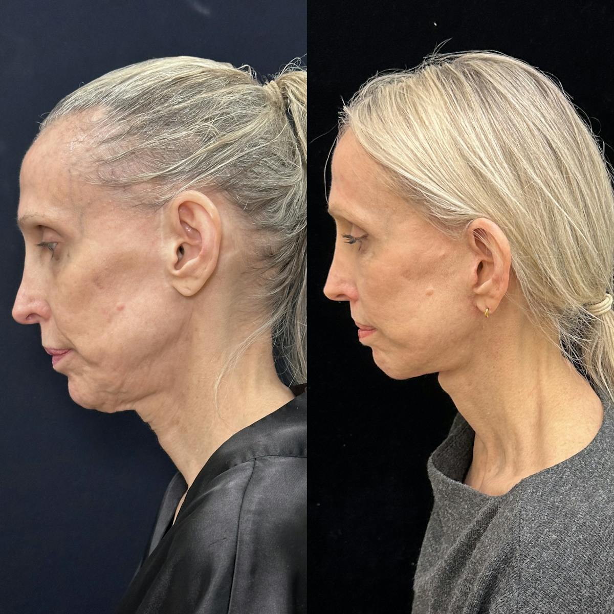 Deep Plane Facelift Before & After Gallery - Patient 988149 - Image 4