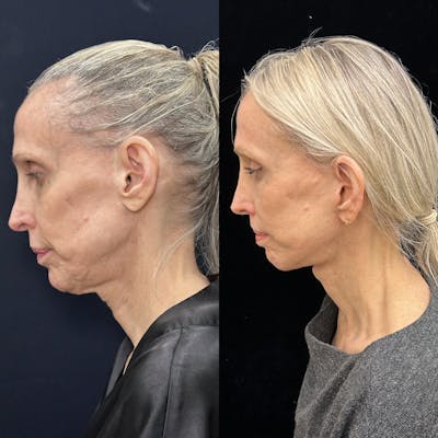 Deep Plane Facelift Before & After Gallery - Patient 988149 - Image 4