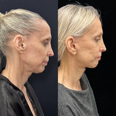 Deep Plane Facelift Before & After Gallery - Patient 988149 - Image 2