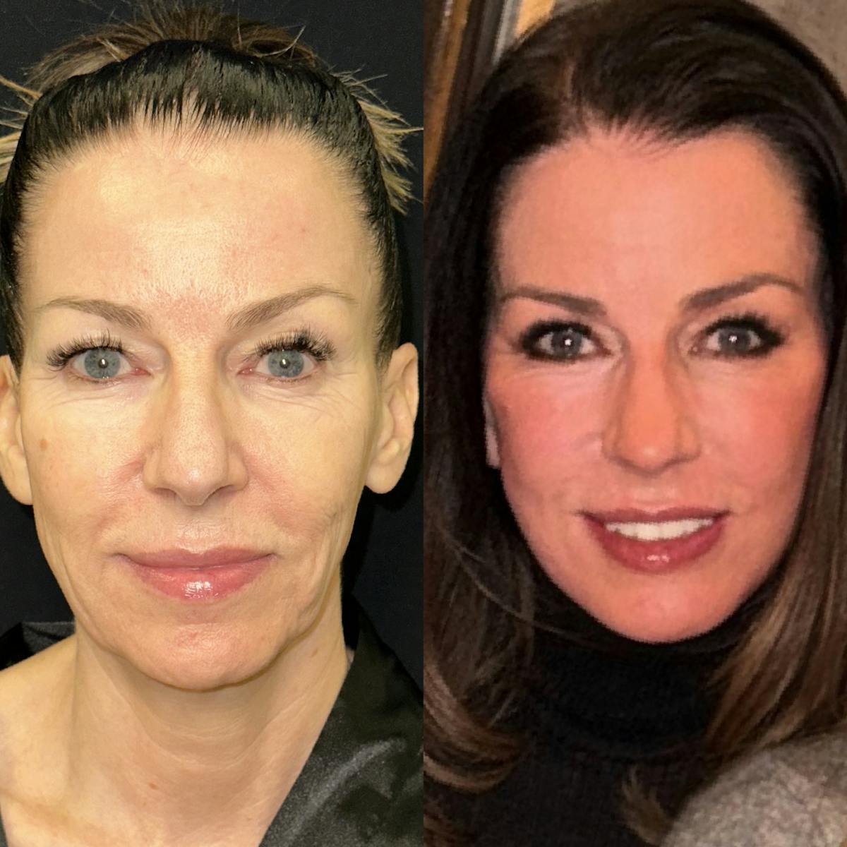 Deep Plane Facelift Before & After Gallery - Patient 394238 - Image 1