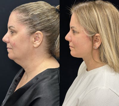 Deep Plane Facelift Before & After Gallery - Patient 382756 - Image 4