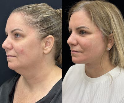 Deep Plane Facelift Before & After Gallery - Patient 382756 - Image 3