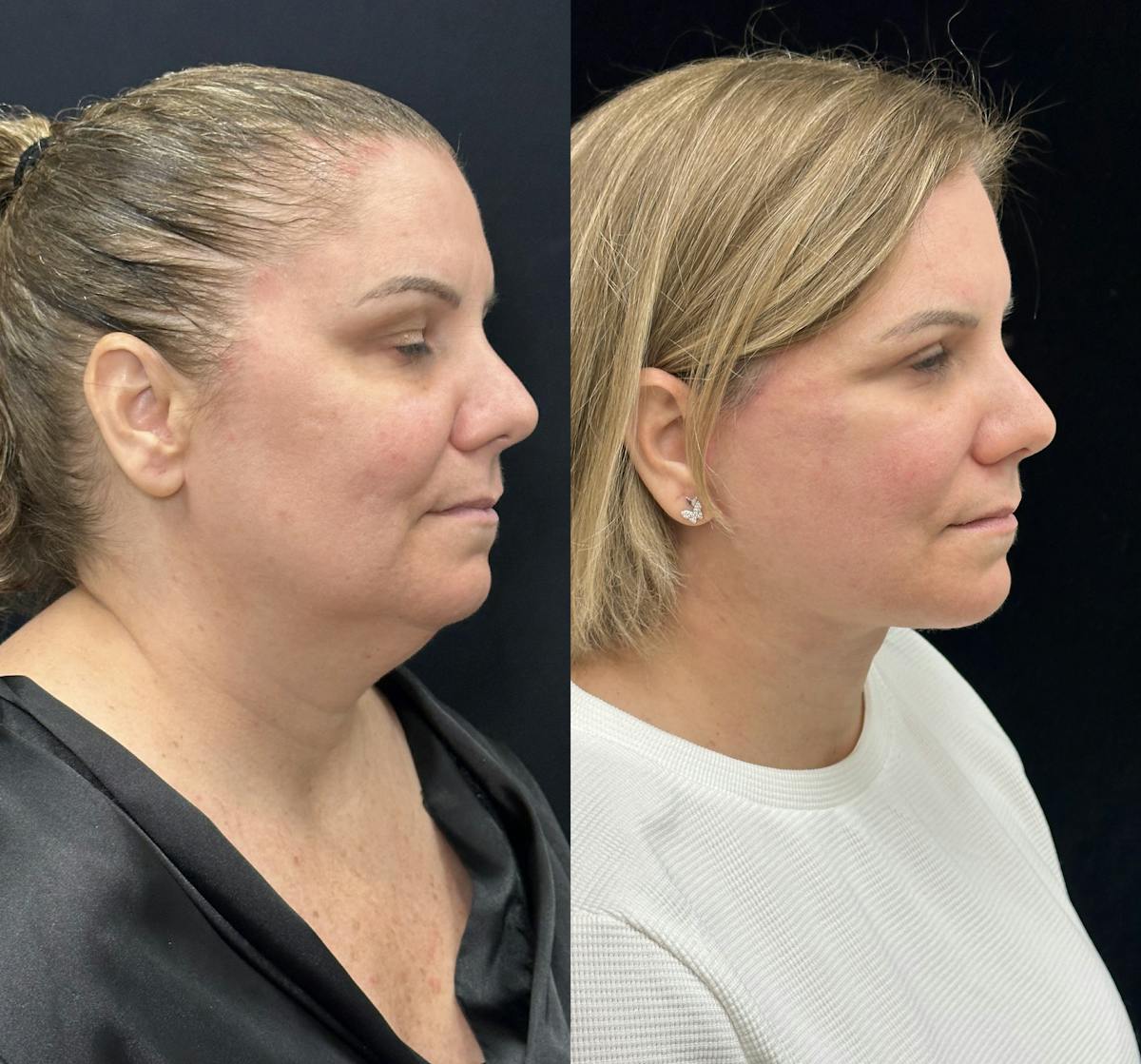 Deep Plane Facelift Before & After Gallery - Patient 382756 - Image 2