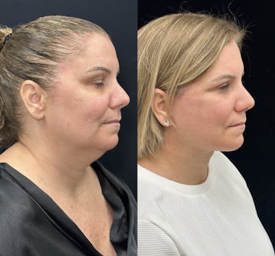 Deep Plane Facelift Before & After Gallery - Patient 382756 - Image 2