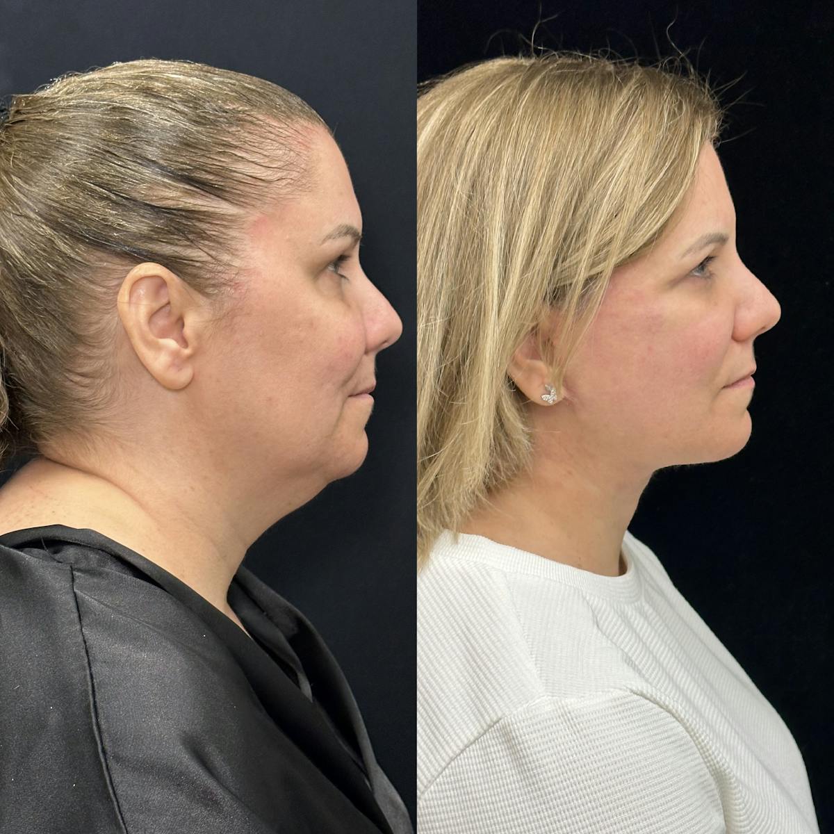 Deep Plane Facelift Before & After Gallery - Patient 382756 - Image 1