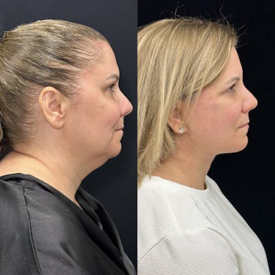 Deep Plane Facelift Before & After Gallery - Patient 382756 - Image 1