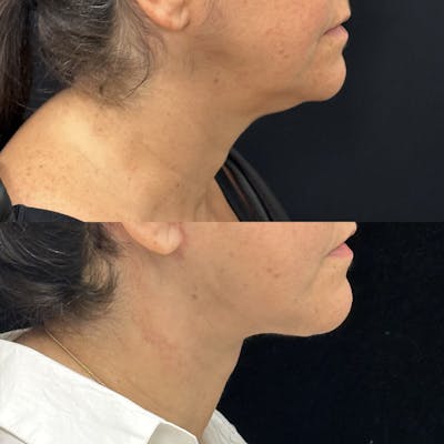 Deep Plane Facelift Before & After Gallery - Patient 193892 - Image 1