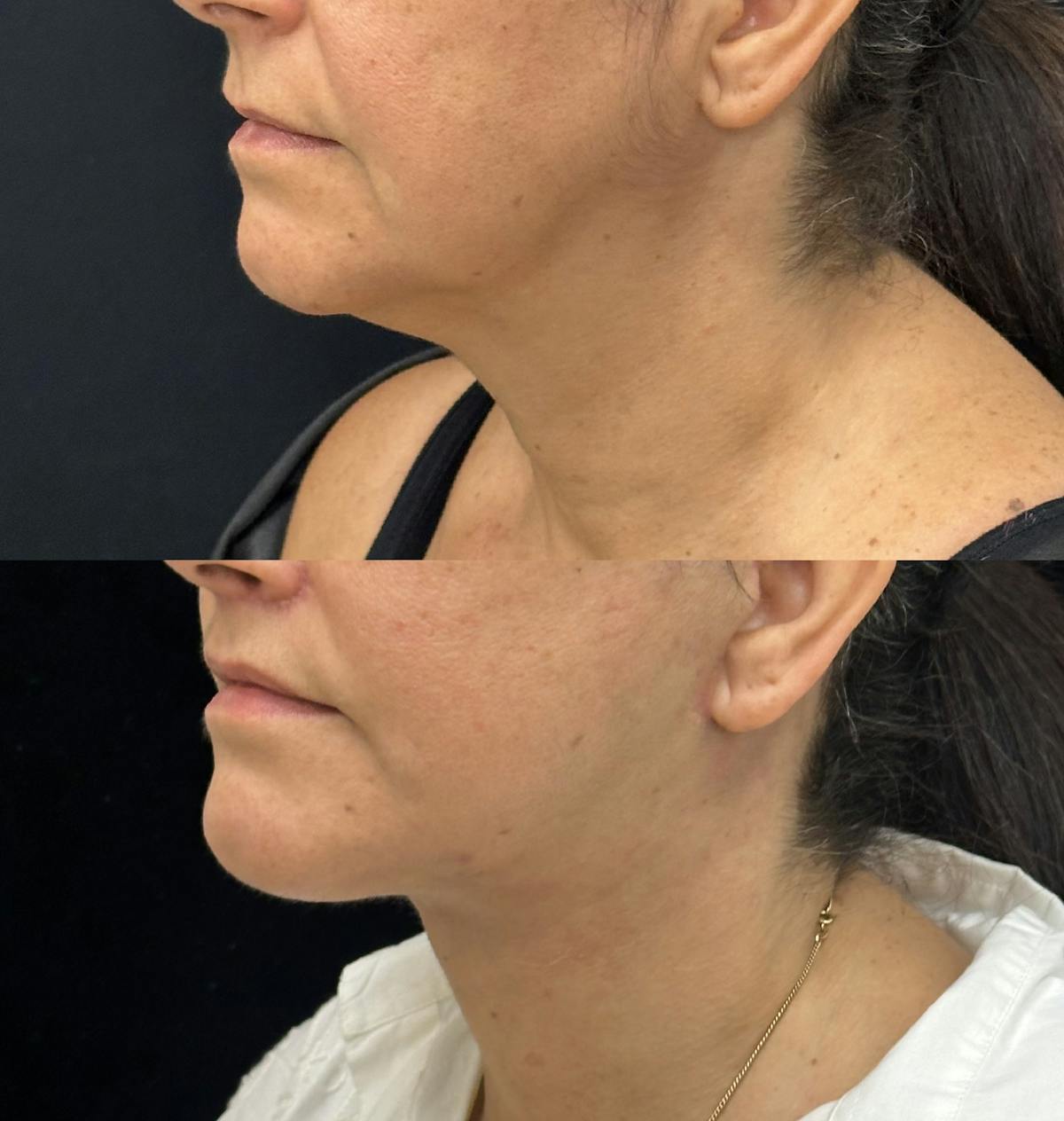 Deep Plane Facelift Before & After Gallery - Patient 193892 - Image 5