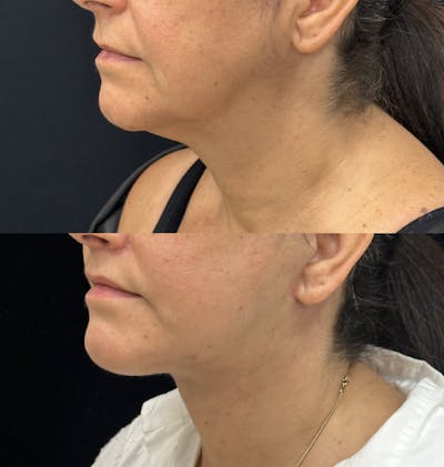 Deep Plane Facelift Before & After Gallery - Patient 193892 - Image 5