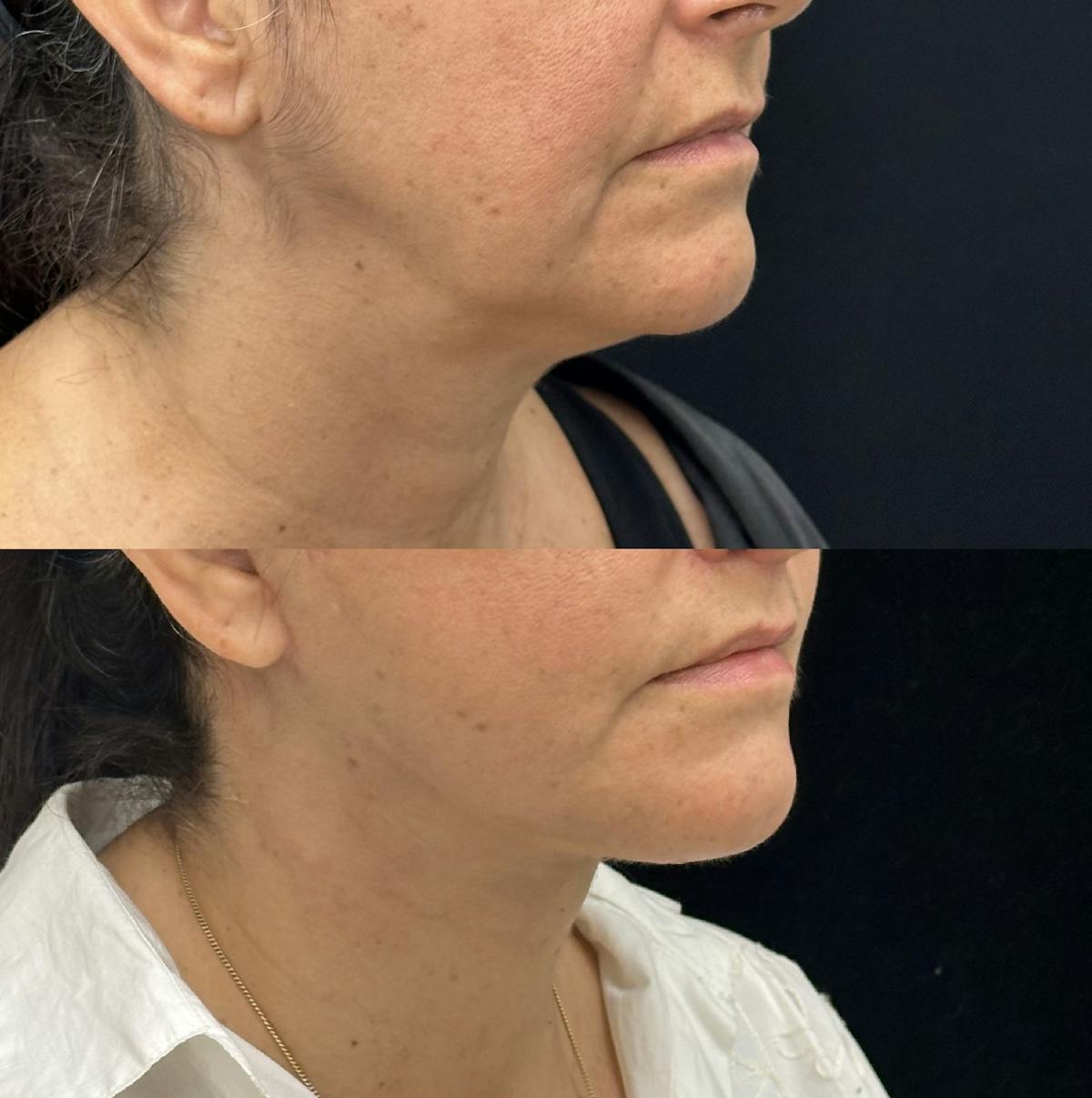 Deep Plane Facelift Before & After Gallery - Patient 193892 - Image 2