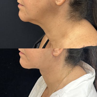 Deep Plane Facelift Before & After Gallery - Patient 193892 - Image 4