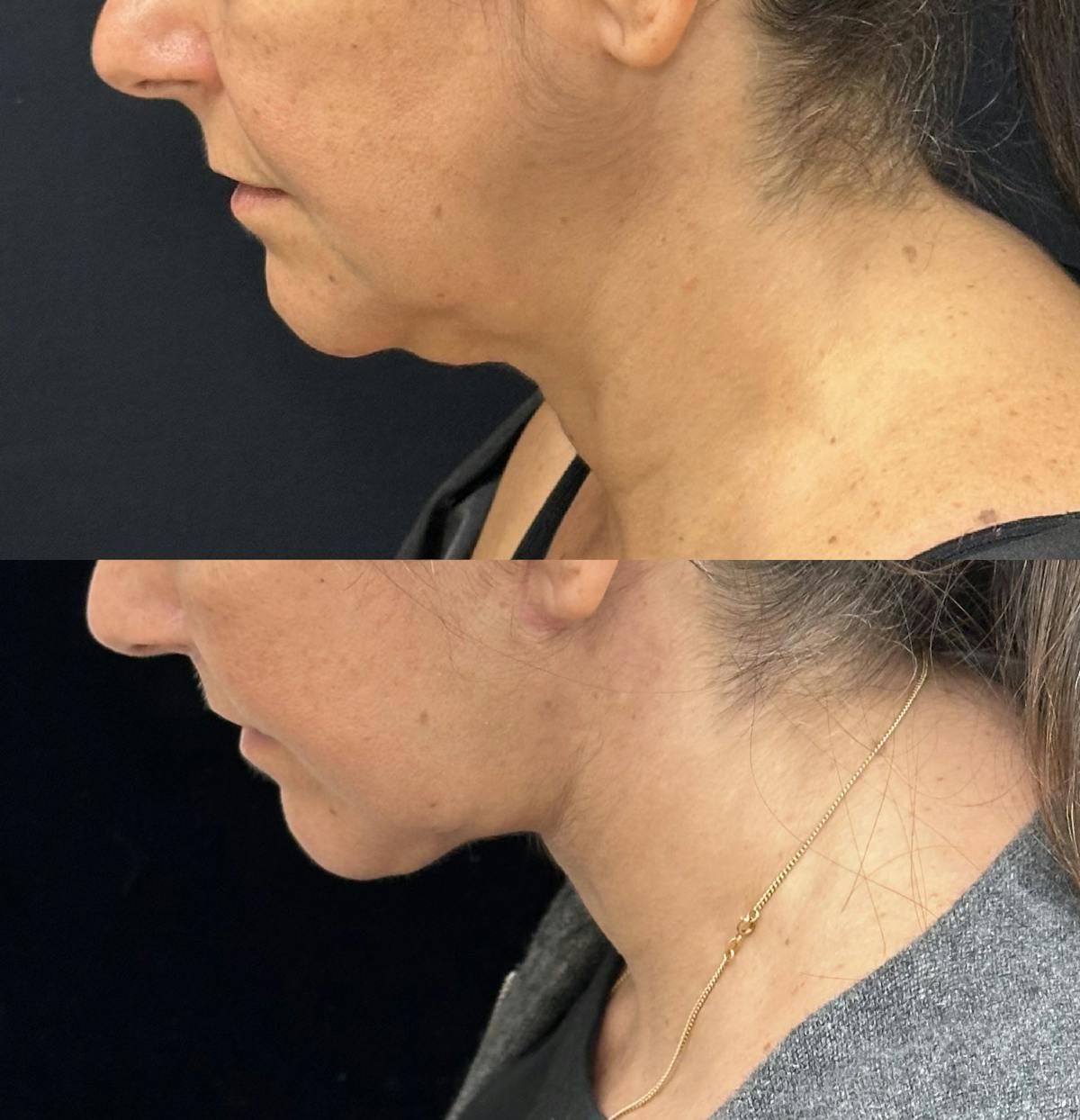 Deep Plane Facelift Before & After Gallery - Patient 193892 - Image 6